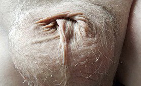 Ultimate Buried Penis