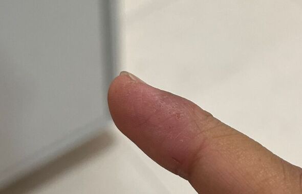 thumb