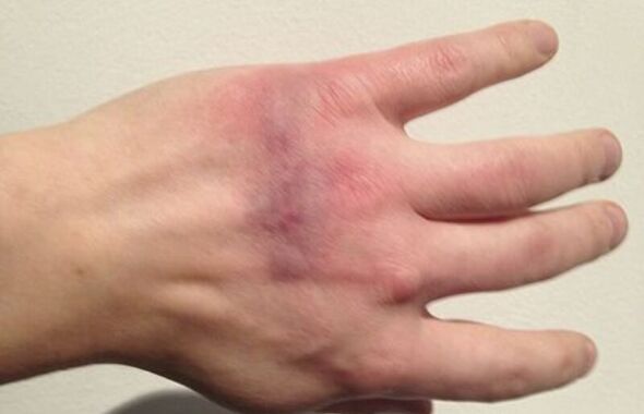 thumb